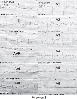 Infarct miocardic post-traumatic la un copil cu traumatisme cranio-cerebrale severe, ediție online