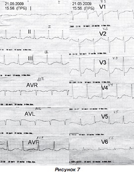 Infarct miocardic post-traumatic la un copil cu traumatisme cranio-cerebrale severe, ediție online