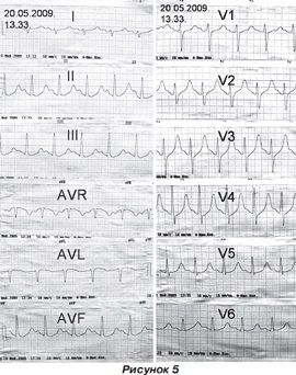 Infarct miocardic post-traumatic la un copil cu traumatisme cranio-cerebrale severe, ediție online