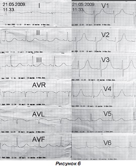 Infarct miocardic post-traumatic la un copil cu traumatisme cranio-cerebrale severe, ediție online