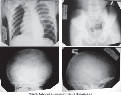 Infarct miocardic post-traumatic la un copil cu traumatisme cranio-cerebrale severe, ediție online