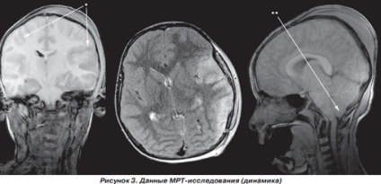 Infarct miocardic post-traumatic la un copil cu traumatisme cranio-cerebrale severe, ediție online