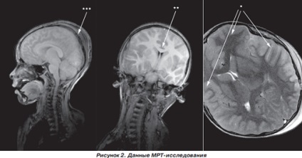 Infarct miocardic post-traumatic la un copil cu traumatisme cranio-cerebrale severe, ediție online