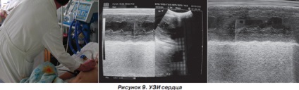 Infarct miocardic post-traumatic la un copil cu traumatisme cranio-cerebrale severe, ediție online