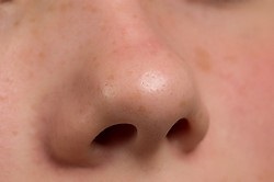 Pimples aproape de nas, sănătate excelentă!