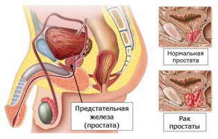 Prostatectomie, Departamentul de Chirurgie High-Tech a Clinicii de Urologie