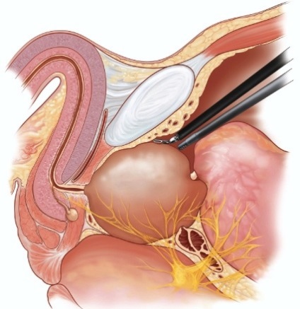 Prostatectomie, Departamentul de Chirurgie High-Tech a Clinicii de Urologie