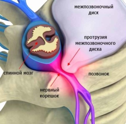 Protruzia discurilor intervertebrale