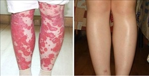 Psoriasis-kezelés hatása látható a szeme