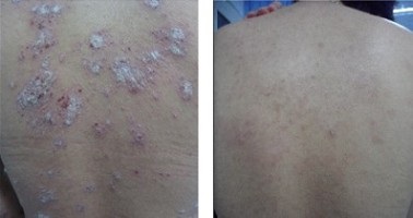 Psoriazisul - efectul tratamentului este vizibil în ochi