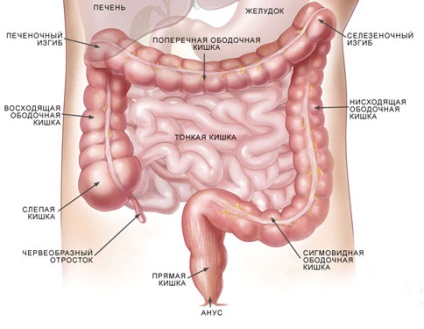 Colon cancer simptome, etape, tratament