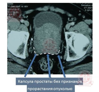 A prosztatarák radikális prostatectomia magas kockázatú klinika urológia első