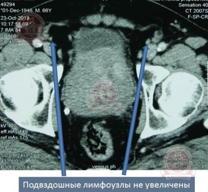 Cancerul de prostată, prostatectomia radicală, riscul oncologic ridicat, clinica de urologie a primului