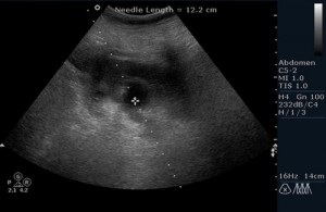 Cancerul de col uterin în semne uzi