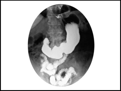 X-ray a gyomor bárium előállítására, eljárások az eredmények