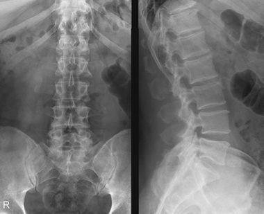 X-sugarak az ágyéki osteochondrosis