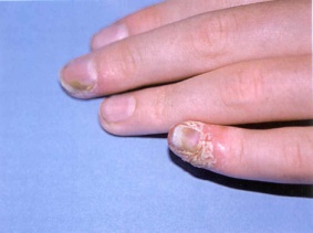 Simptomele bolilor unghiilor de leziuni ale unghiilor la diferite boli sunt adesea similare