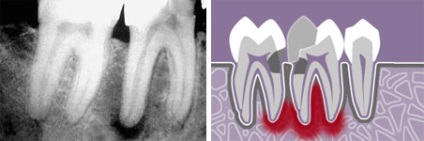 Simptomele și tratamentul parodontitei acute și cronice - la domiciliu, droguri,