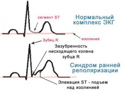 Sindromul repolarizării ventriculare precoce a cauzei, semne, tratament