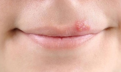 Erupții asupra simptomelor și tratamentului buzelor