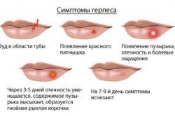 Erupții asupra simptomelor și tratamentului buzelor