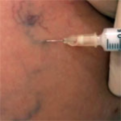 Scleroterapia cu vene varicoase - o nouă metodă de tratare a venelor varicoase