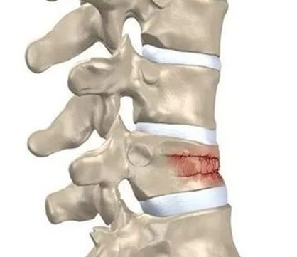 Deplasarea coloanei vertebrale lombare, simptome, tratament, exerciții