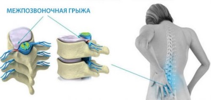 Deplasarea coloanei vertebrale lombare, simptome, tratament, exerciții