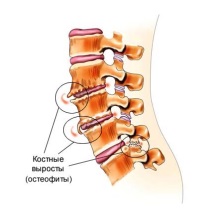 Spondiloza coloanei vertebrale, simptome și metode de tratament - clinica 