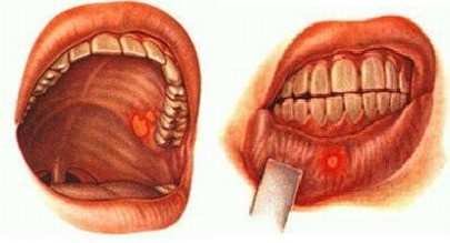 Stomatita ce este, cauze, simptome, tipuri si tratament - dinte medic