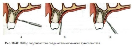 Grefele gingivale gratuite