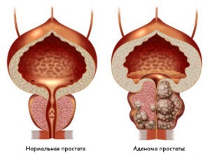 Tabletele din adenomul prostatic - care sunt cele mai eficiente