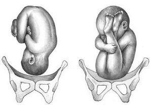 Poziția pelviană a copilului la 32 de săptămâni de sarcină este ceea ce este, caracteristicile gluteului