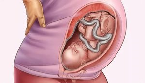 Poziția pelviană a copilului la 32 de săptămâni de sarcină este ceea ce este, caracteristicile gluteului