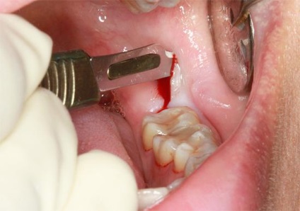 Tehnică pentru extracția dinților pe maxilarul superior și inferior