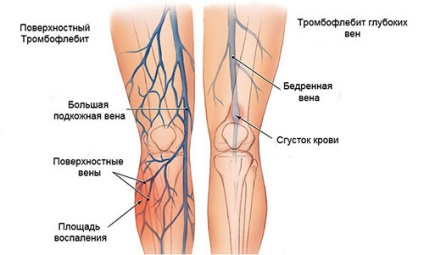 Thrombophlebitis vénák akut trombózis Shin mély, a tünetek és a kezelés, a visszértágulatok kezelésében