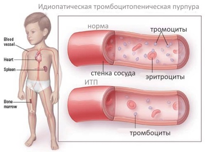 Trombocitopenic purpura este o boală a verlghof