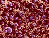 Trombocitopenic purpura este o boală a verlghof
