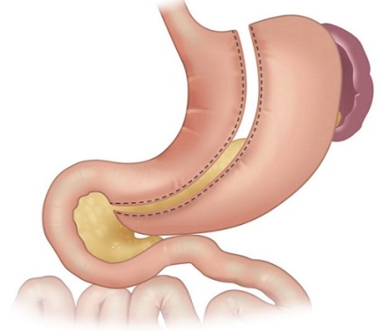 Eliminarea ulcerului gastric și a efectelor acestuia