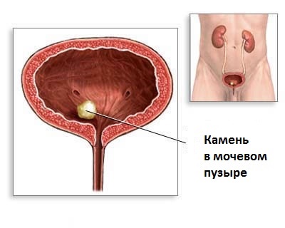 Urolesan cu cistită, indicații de utilizare, contraindicații și efecte secundare