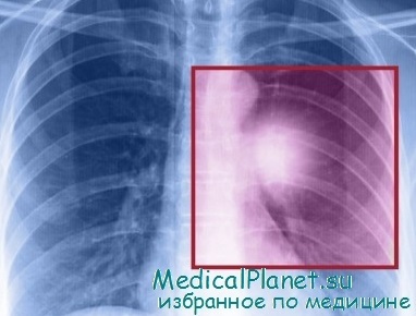 Evaluarea Uzi a răspândirii intrathoracice a tumorii pulmonare