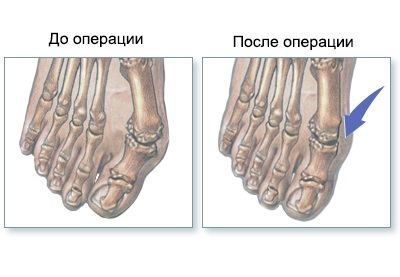 Valgus deformare a bolii piciorului și reabilitare