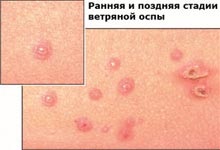 Varicella (varicelă) - simptome, tratament