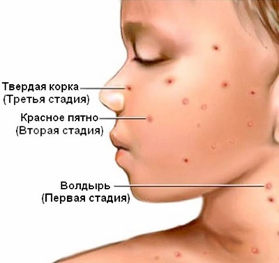 Variola de vită (varicelă)
