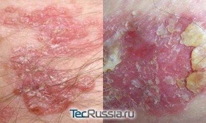 Típusú tumorok a bőrön, az arc és a test - fotó