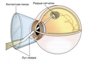 Influența diferitelor tipuri de lasere asupra sănătății medicului și pacientului