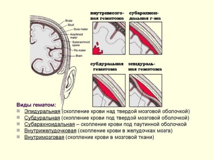 възпаление на гръбначния мозък