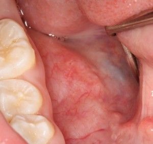 Inflamația sub limbă și umflarea glandei salivare