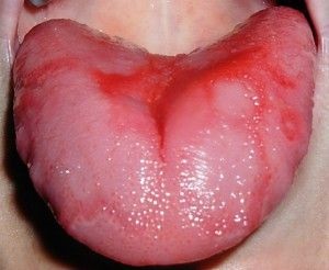 Inflamația papilelor în limbajul simptomelor bolii