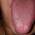 Papillák gyulladása a nyelv tüneteiben